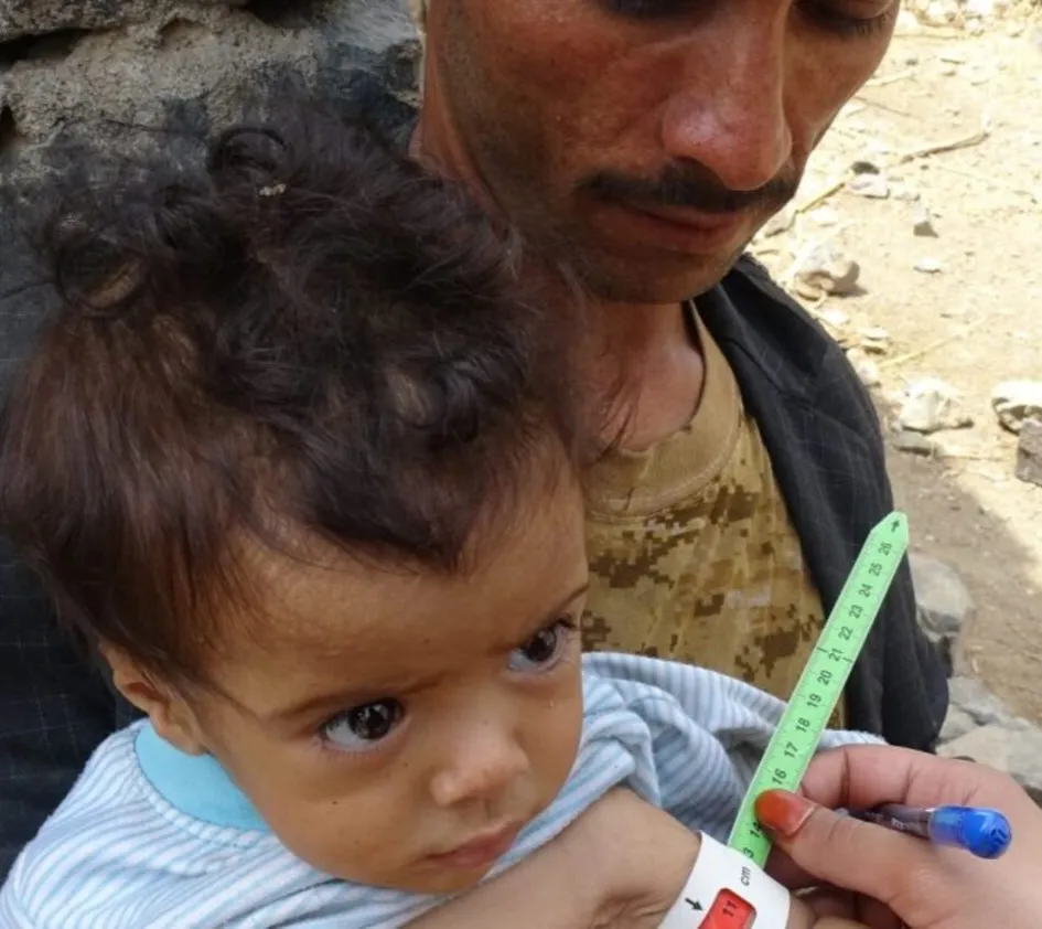 Krieg im Jemen: Mitarbeiter misst Armumfang eines unterernährten Kindes
