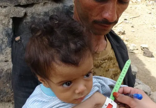 Krieg im Jemen: Mitarbeiter misst Armumfang eines unterernährten Kindes